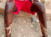 11 yrs after battling with wounds in two legs, young man cry out for help in Bauchi